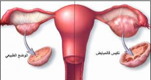 تأثير تناول المغنسيوم كعلاج لتكيس المبايض 