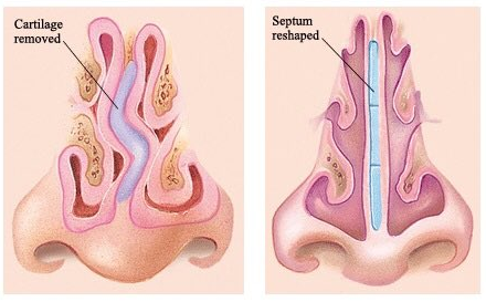 انحراف الحاجز الانفي واللحمية