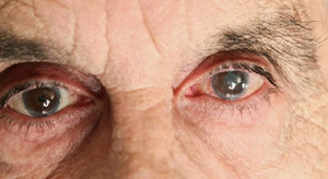 أسباب التهاب العين بعد عملية المياه البيضاء