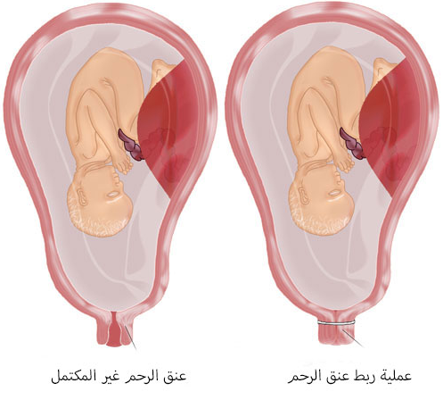 أسباب ربط عنق الرحم