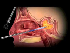 عملية تسليك الجيوب الأنفية بالمنظار 