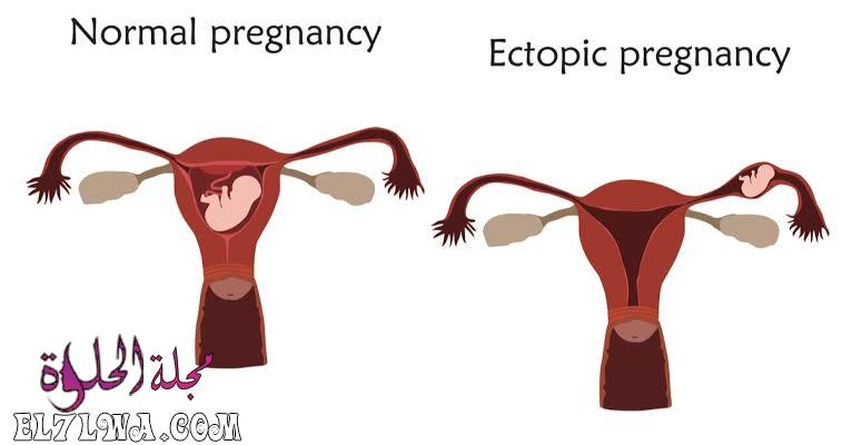 اعراض الحمل خارج الرحم بالصور