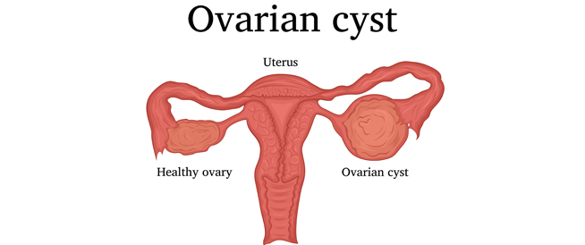 Ovarian cyst