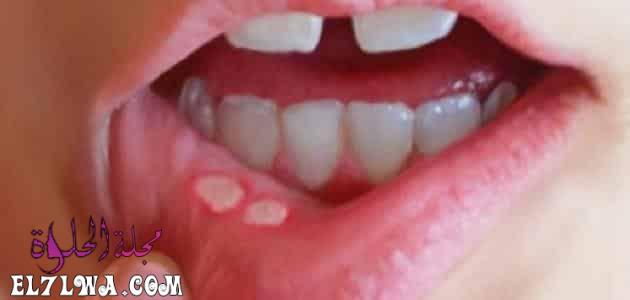 دكتارين Daktarin لعلاج الفطريات الفم واللسان