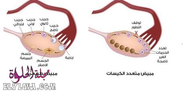 ما هي نسبة حدوث الحمل مع تكيس المبايض