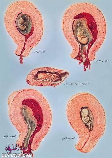 أعراض بقايا المشيمة في الرحم بعد الإجهاض