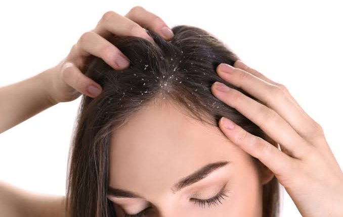 أفضل علاج للقشرة من الصيدلية