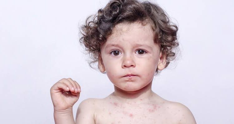 الحساسية الموسمية عند الأطفال