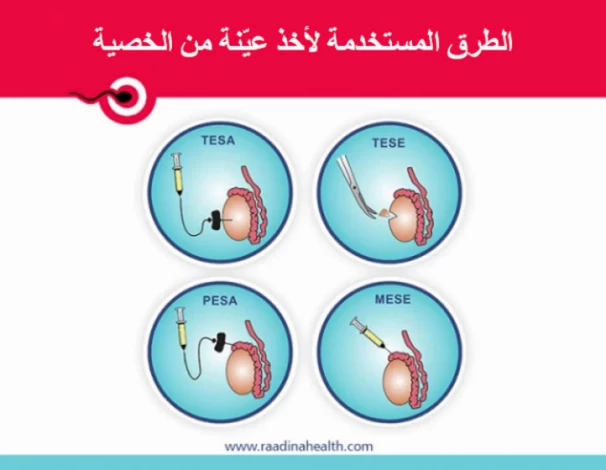 الطرق المستخدمة لأخذ عينة من الخصية