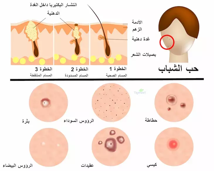 كريم سكينورين Skinoren لعلاج حب الشباب