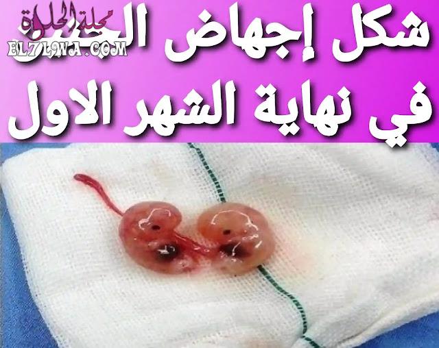 شكل اجهاض الجنين في نهاية الشهر الأول